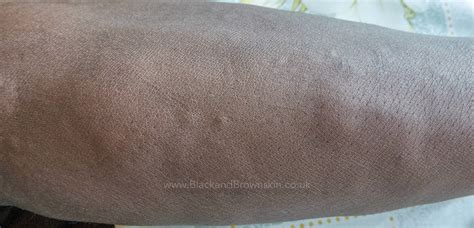 Black Jack Urticaria