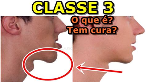 Classe 2 E Classe 3 Maquinas De Fenda